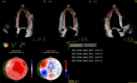 philips lv|AutoStrain LV application .